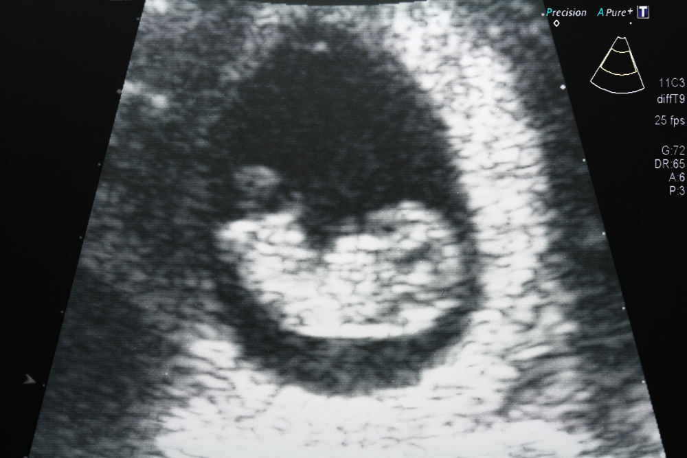 10 Weeks Pregnant Baby Ultrasound